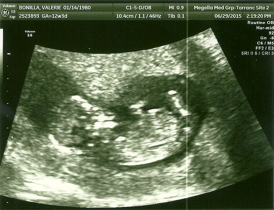 babybean-scan-12wks